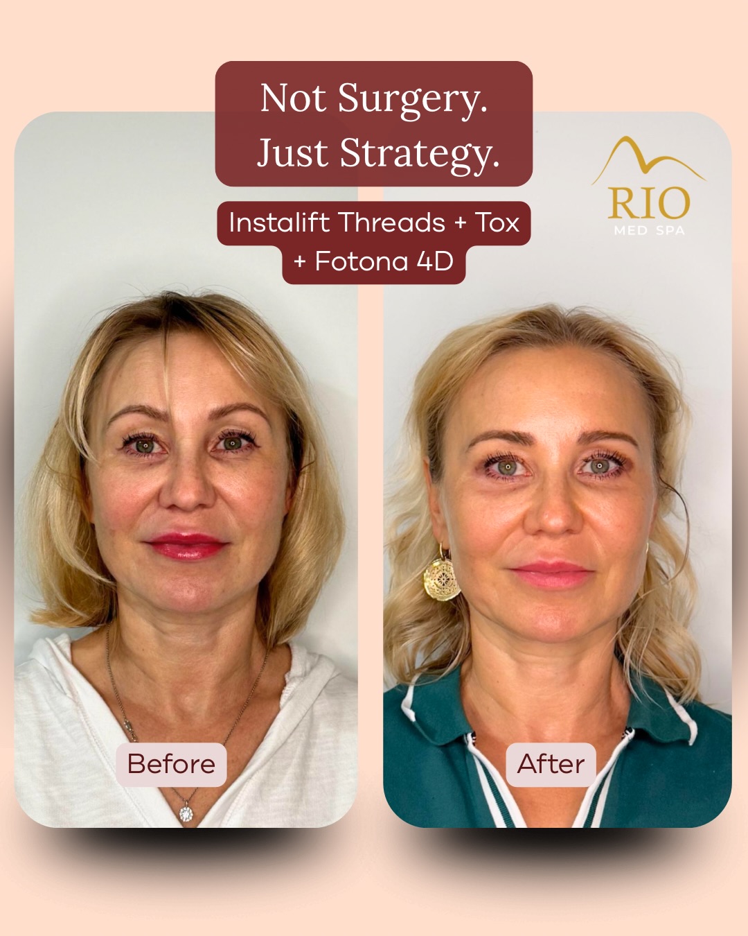 Rio Med Spa before-and-after treatment carousel: Instalift threads, tox and Fotona 4D
